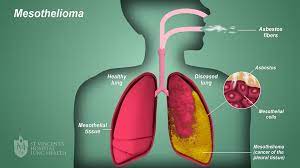 What Is Mesotheliomam, Symptoms, Lawyer, Cancer Mesothelioma and More