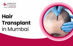 Hair Transplant in India