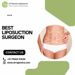 Liposuction Surgery in Bangalore | Safe & Effective Fat Removal