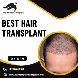 Hair Transplant Clinics in Bangalore | Hair Transplant Cost