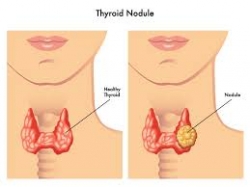 Highly Skilled Thyroid Nodule Treatment Service Providers at IR Facilities